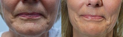 CO2 Laser Resurfacing Before & After Gallery - Patient 411090 - Image 1