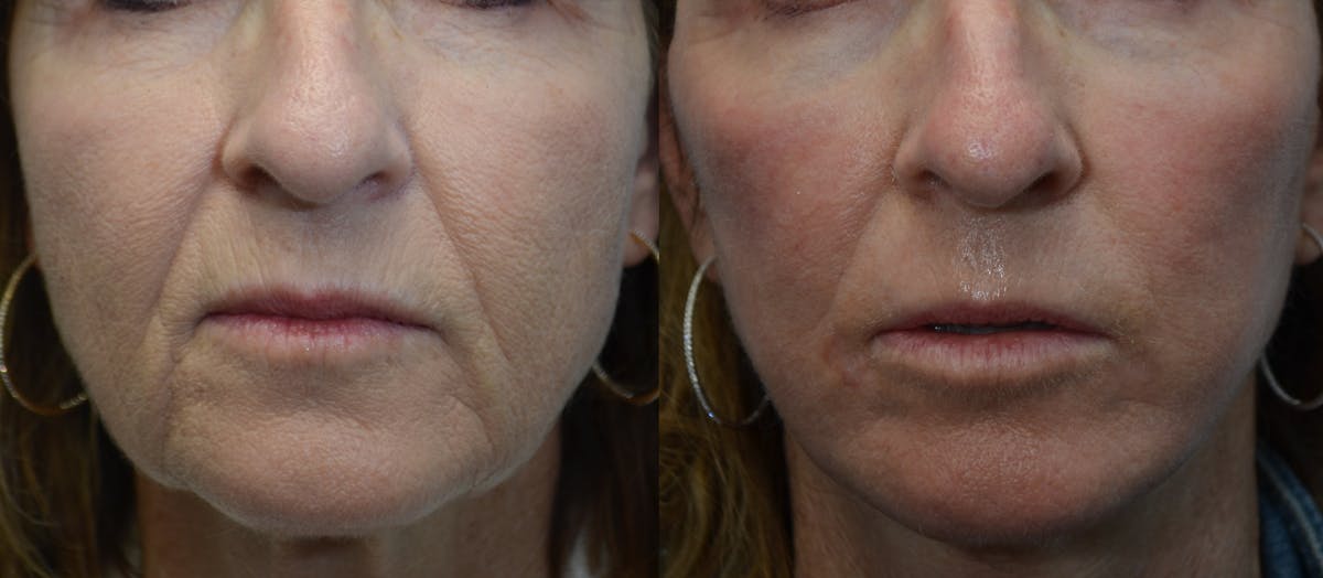 CO2 Laser Resurfacing Before & After Gallery - Patient 411090 - Image 3