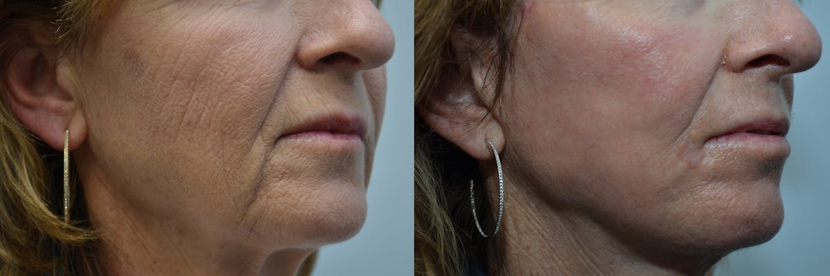 CO2 Laser Resurfacing Before & After Gallery - Patient 411090 - Image 4