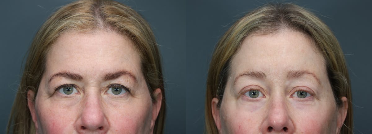 CO2 Laser Resurfacing Before & After Gallery - Patient 364551 - Image 1