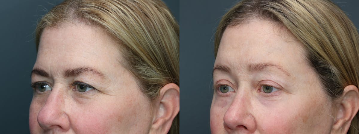 CO2 Laser Resurfacing Before & After Gallery - Patient 364551 - Image 2