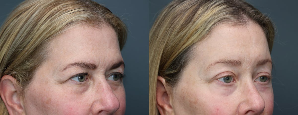 CO2 Laser Resurfacing Before & After Gallery - Patient 364551 - Image 3