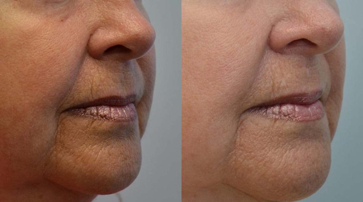 RF Microneedling Before & After Gallery - Patient 197730 - Image 1