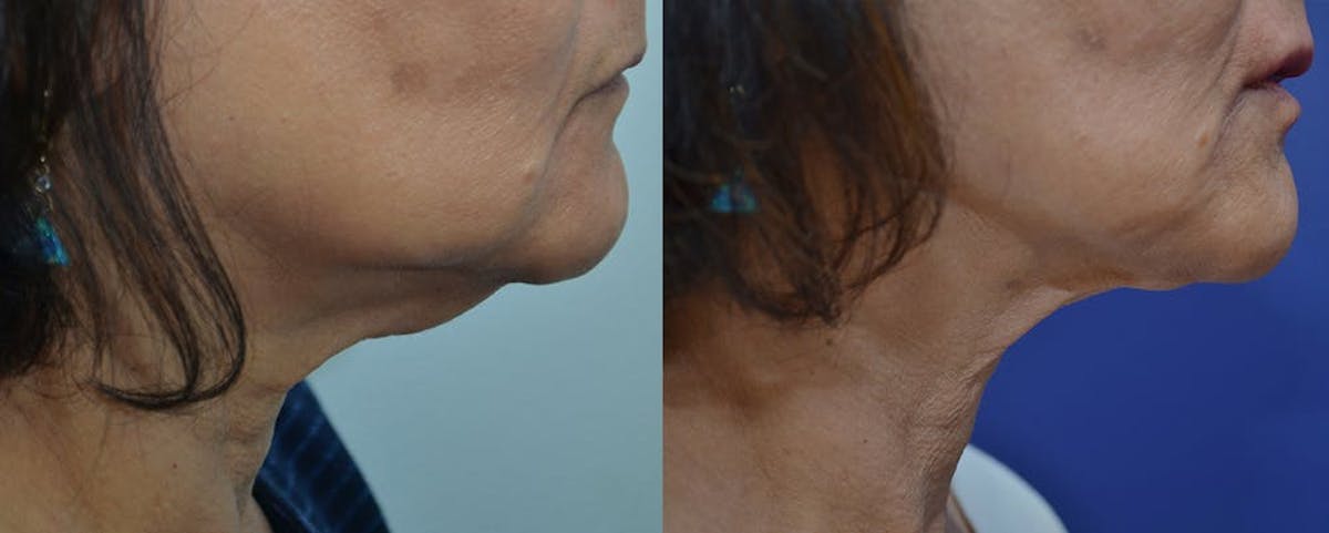 RF Microneedling Before & After Gallery - Patient 409989 - Image 1