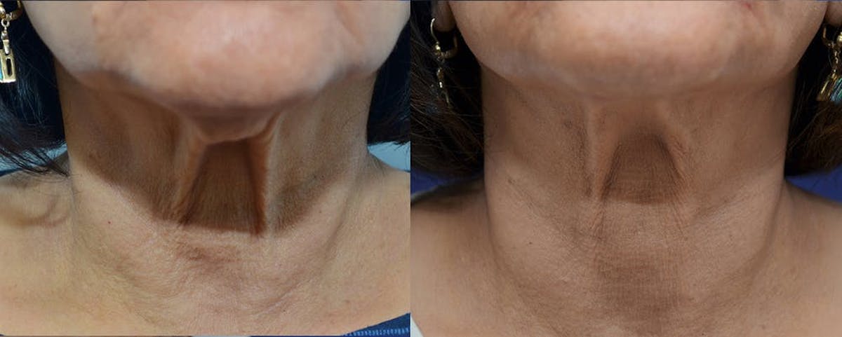 RF Microneedling Before & After Gallery - Patient 409989 - Image 2