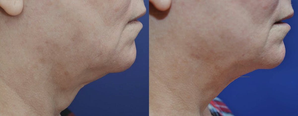 RF Microneedling Before & After Gallery - Patient 370276 - Image 1
