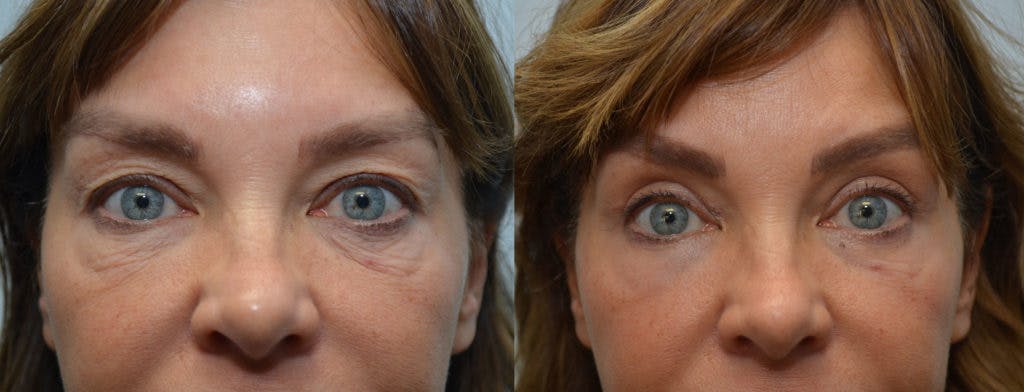 Forma Before & After Gallery - Patient 102714 - Image 1