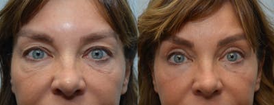 Forma Before & After Gallery - Patient 102714 - Image 1