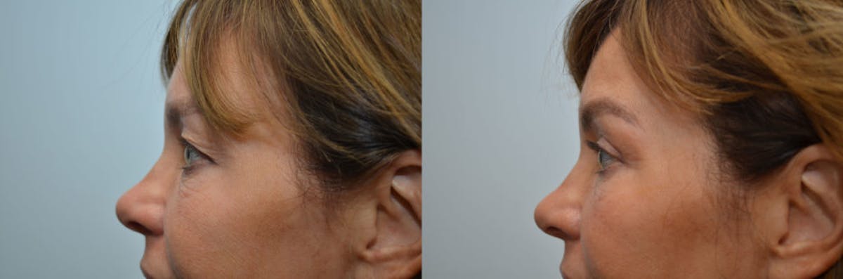 Forma Before & After Gallery - Patient 102714 - Image 3