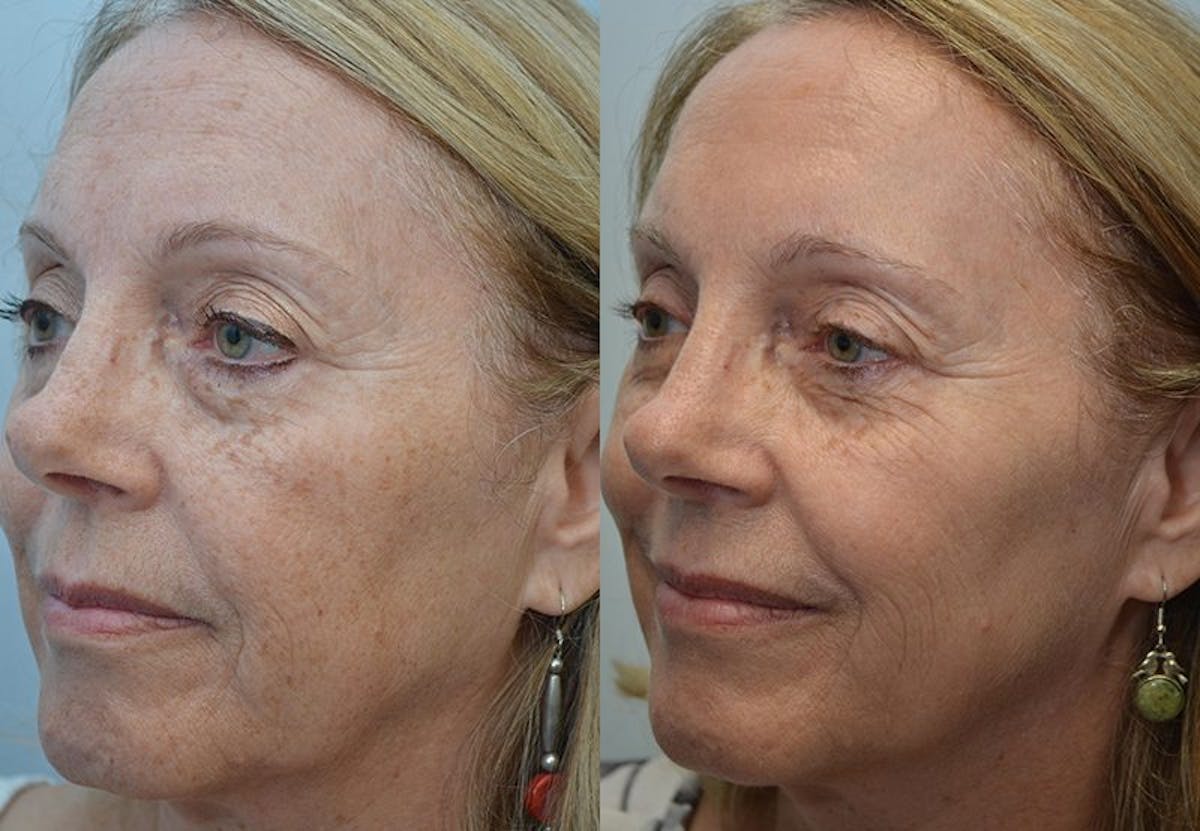 IPL / PhotoFacial Before & After Gallery - Patient 720700 - Image 1
