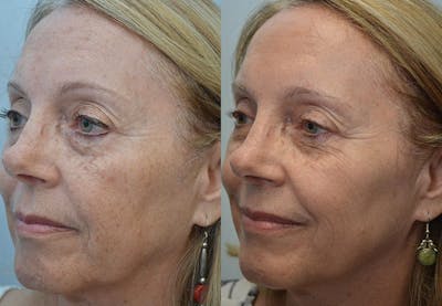 IPL / PhotoFacial Before & After Gallery - Patient 720700 - Image 1