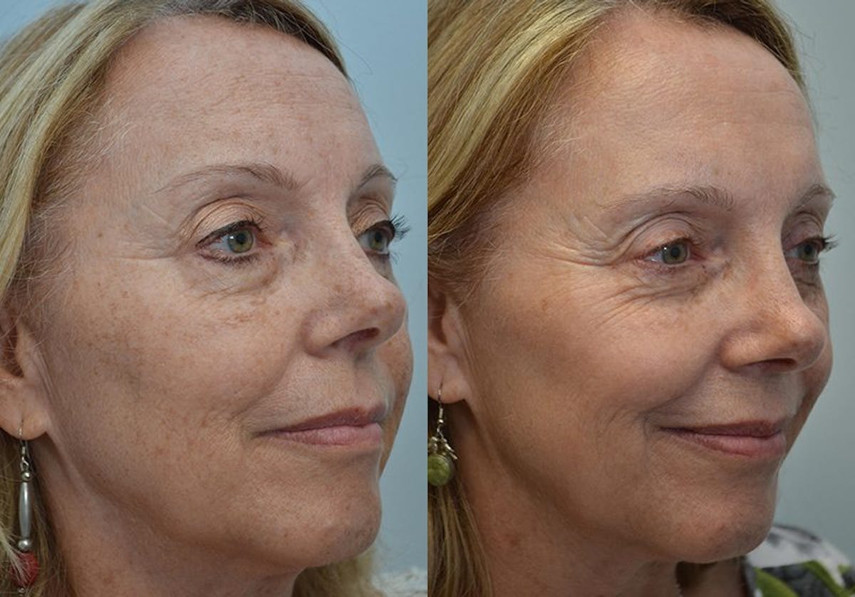 IPL / PhotoFacial Before & After Gallery - Patient 720700 - Image 2