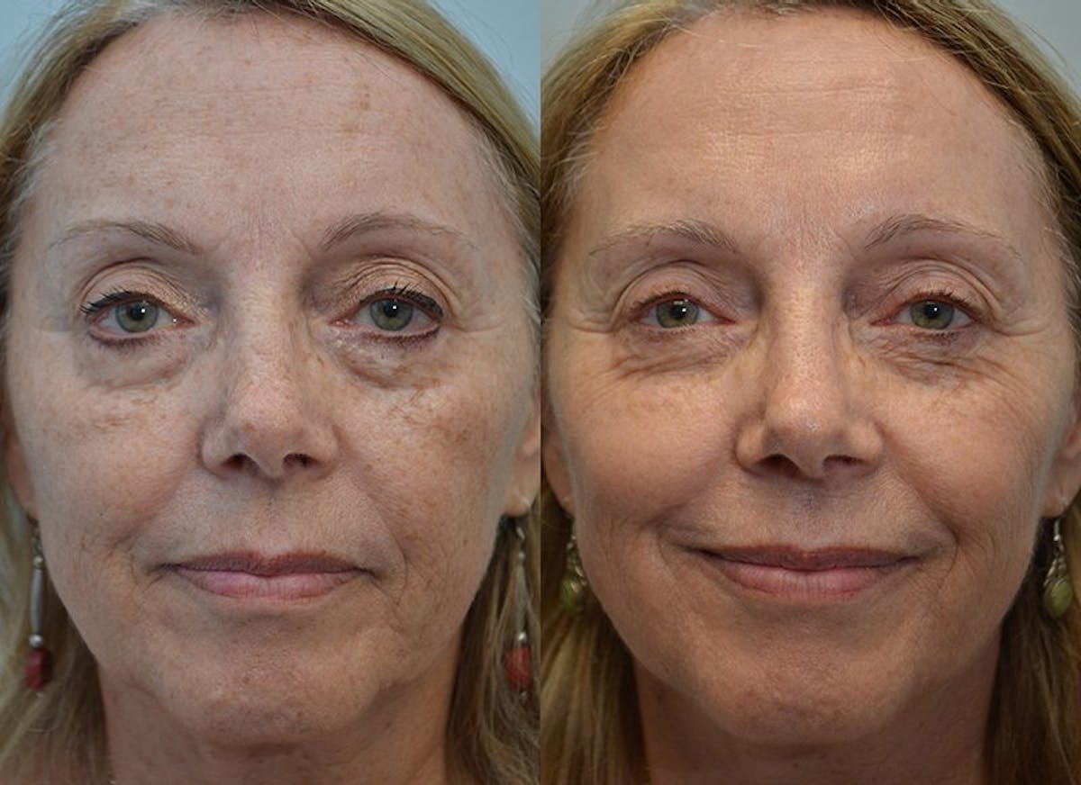 IPL / PhotoFacial Before & After Gallery - Patient 720700 - Image 3