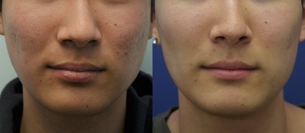 Microneedling Before & After Gallery - Patient 332229 - Image 1