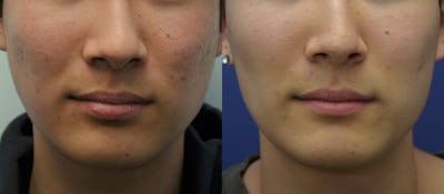 Microneedling Before & After Gallery - Patient 332229 - Image 1