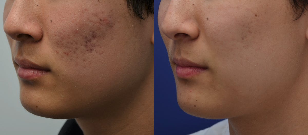Microneedling Before & After Gallery - Patient 332229 - Image 2