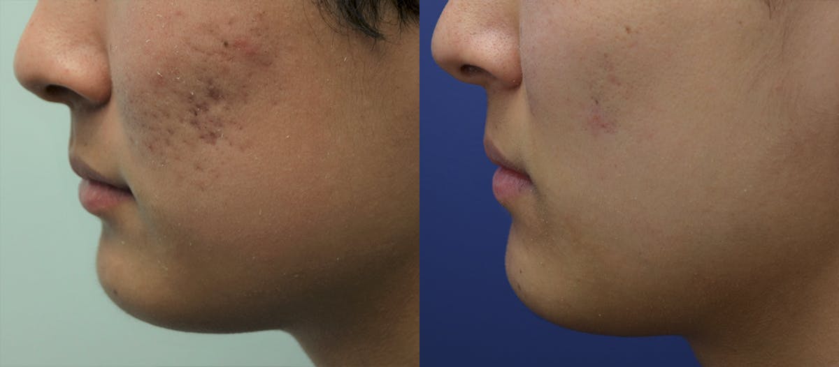 Microneedling Before & After Gallery - Patient 332229 - Image 3
