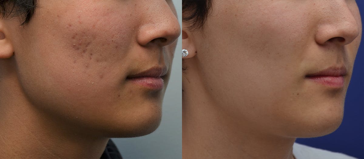Microneedling Before & After Gallery - Patient 332229 - Image 4