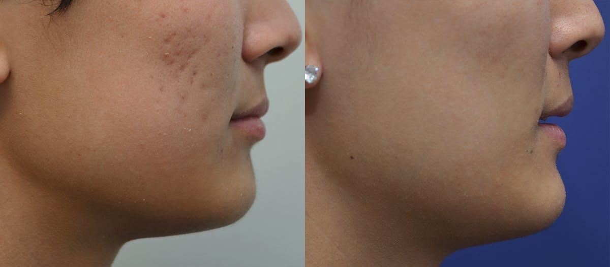 Microneedling Before & After Gallery - Patient 332229 - Image 5