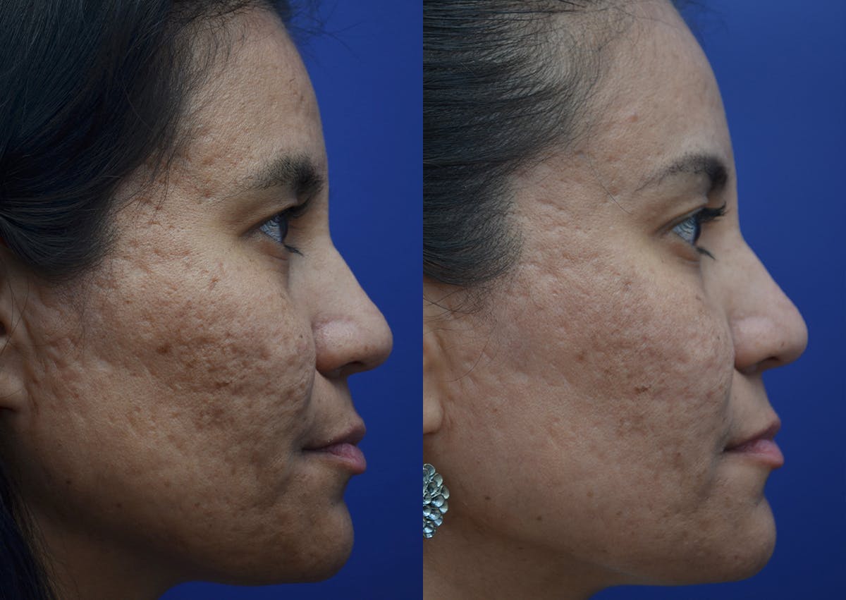 Microneedling Before & After Gallery - Patient 308604 - Image 2