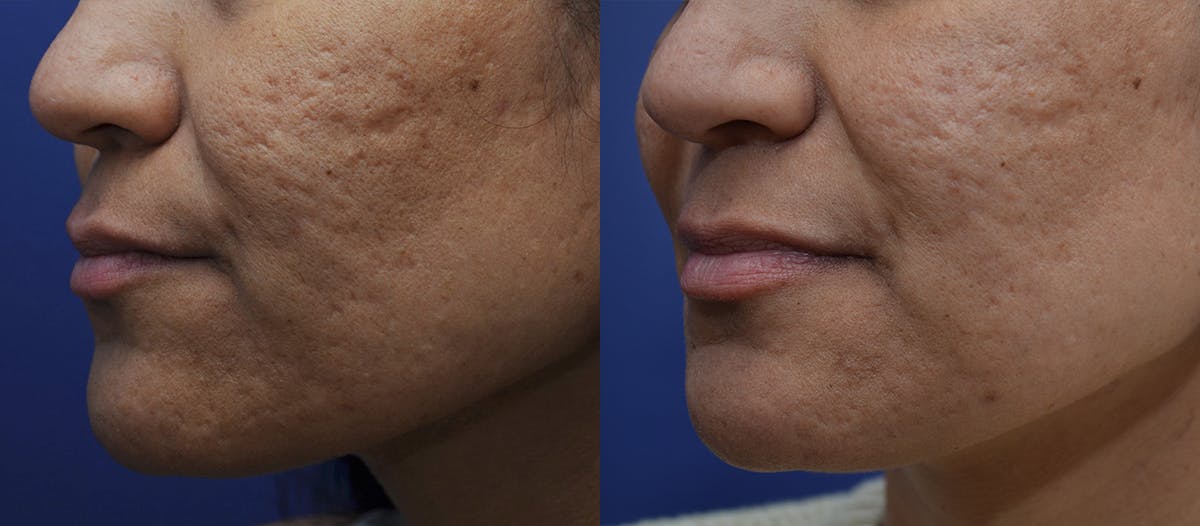 Microneedling Before & After Gallery - Patient 308604 - Image 3