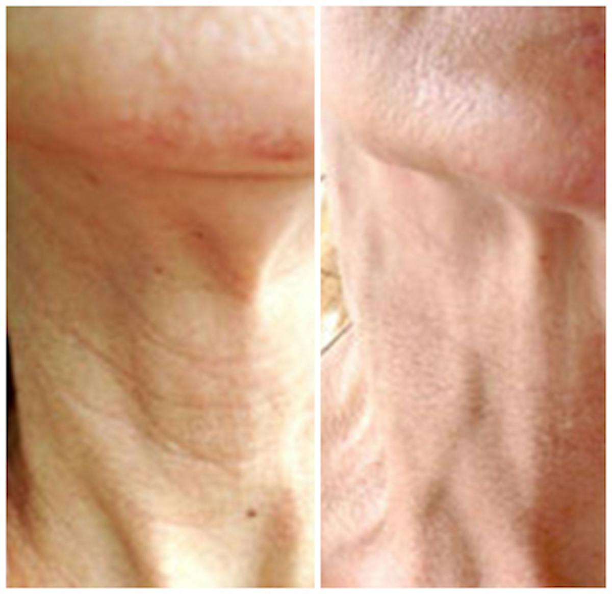 Microneedling Before & After Gallery - Patient 725649 - Image 1