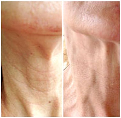 Microneedling Before & After Gallery - Patient 725649 - Image 1