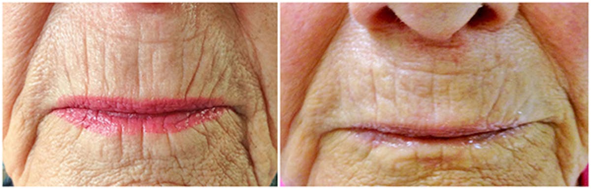 Microneedling Before & After Gallery - Patient 416991 - Image 1