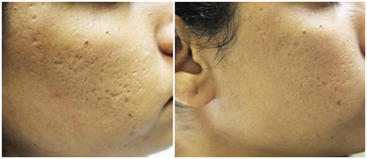 Microneedling Before & After Gallery - Patient 239134 - Image 1
