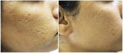 Microneedling Before & After Gallery - Patient 239134 - Image 1
