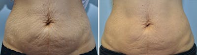Microneedling Before & After Gallery - Patient 369908 - Image 1