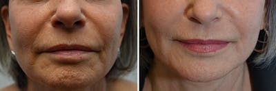 Microneedling Before & After Gallery - Patient 249977 - Image 1