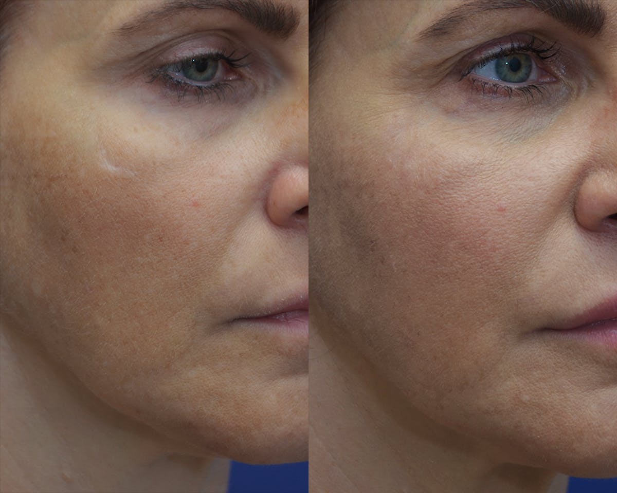 Scar Revision Before & After Gallery - Patient 393601 - Image 1