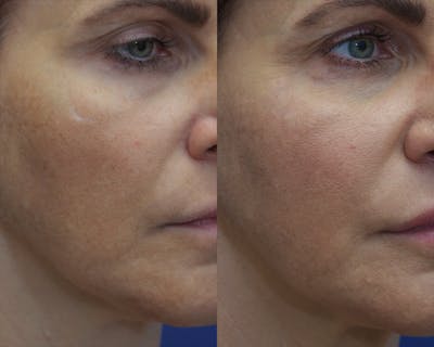 Scar Revision Before & After Gallery - Patient 393601 - Image 1
