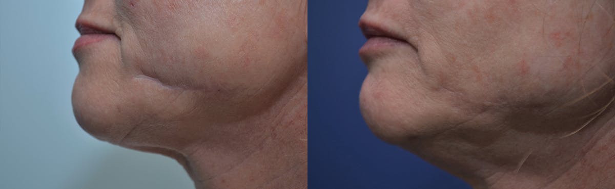 Scar Revision Before & After Gallery - Patient 203481 - Image 1
