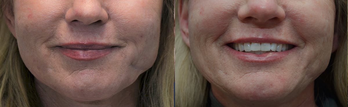 Scar Revision Before & After Gallery - Patient 203481 - Image 2