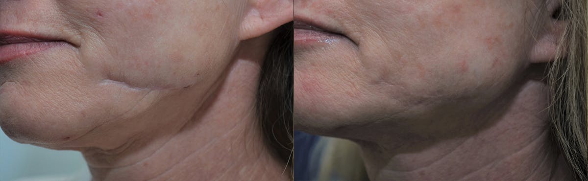 Scar Revision Before & After Gallery - Patient 203481 - Image 3