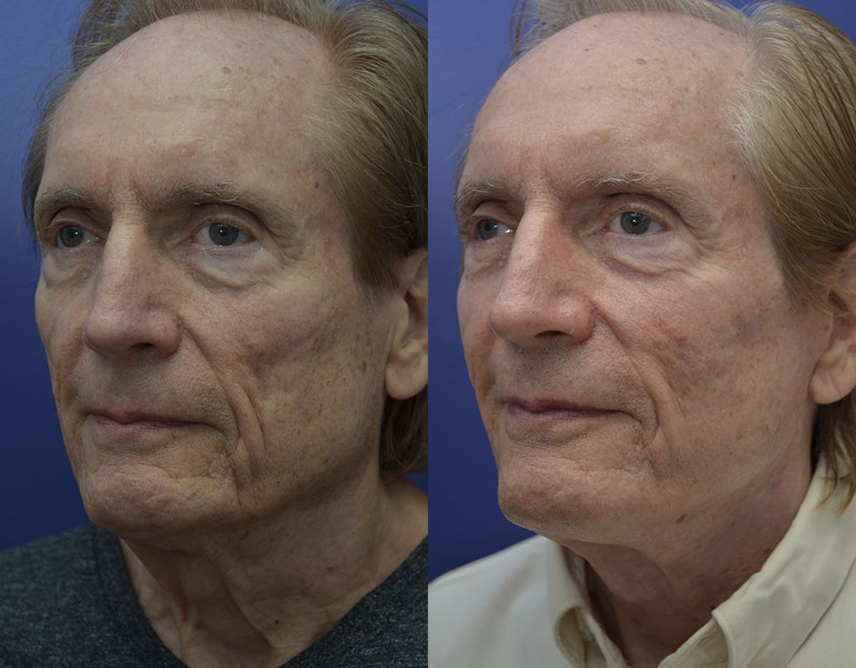Sculptra Before & After Gallery - Patient 306560 - Image 2