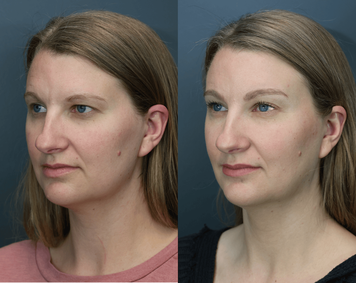 Eyelid Surgery Before & After Gallery - Patient 218886 - Image 2