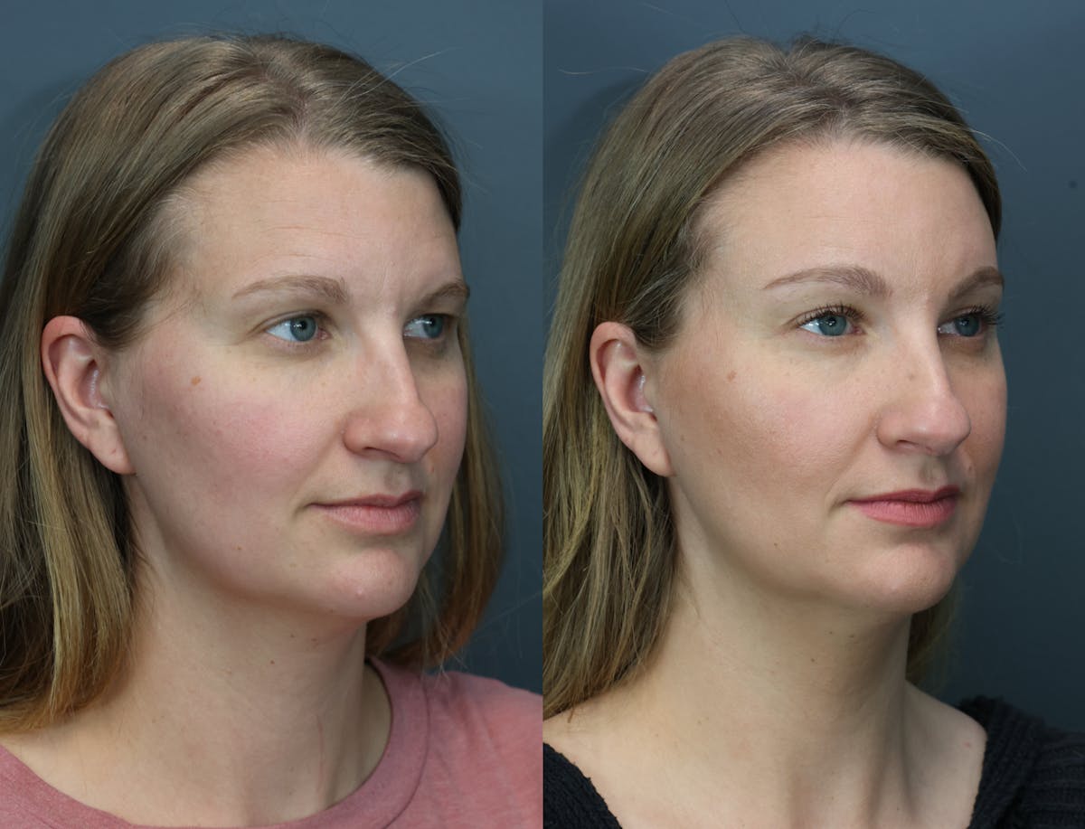 Eyelid Surgery Before & After Gallery - Patient 218886 - Image 3