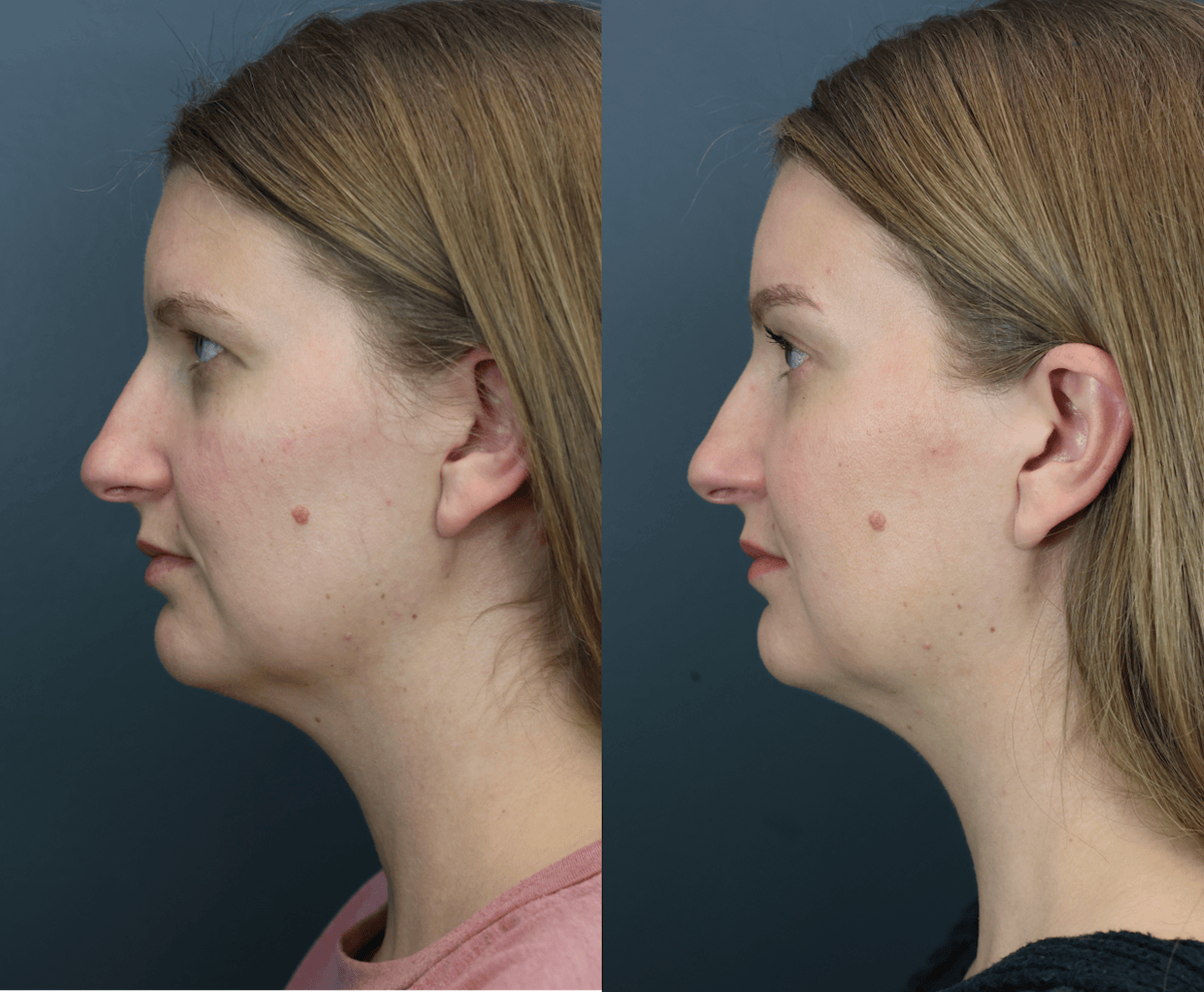Eyelid Surgery Before & After Gallery - Patient 218886 - Image 4