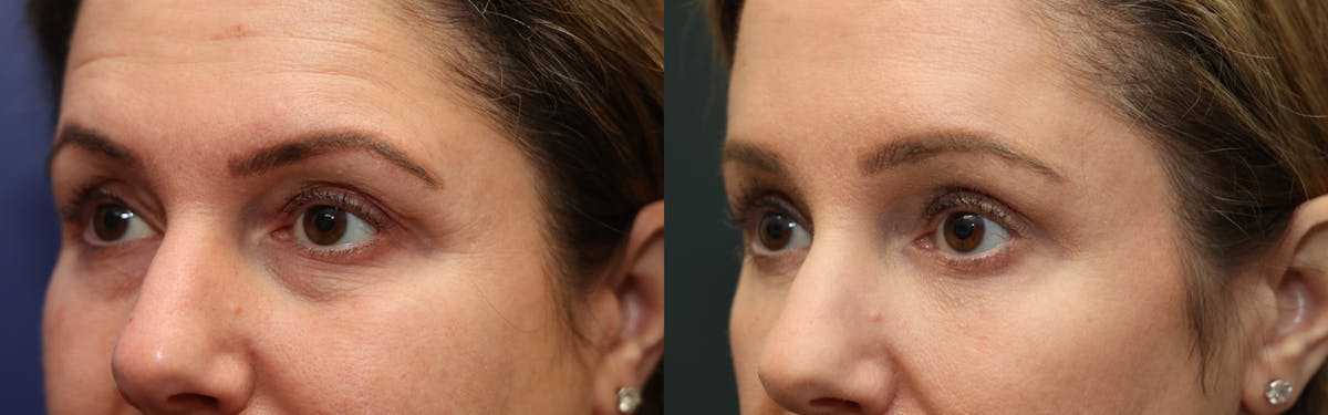 Eyelid Surgery Before & After Gallery - Patient 246416 - Image 3