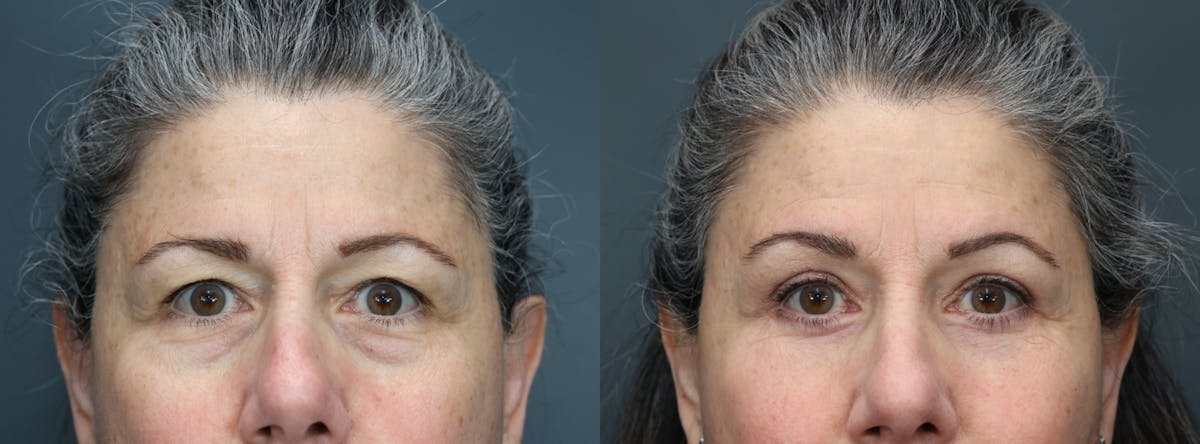 Blepharoplasty Before & After Gallery - Patient 119426 - Image 1