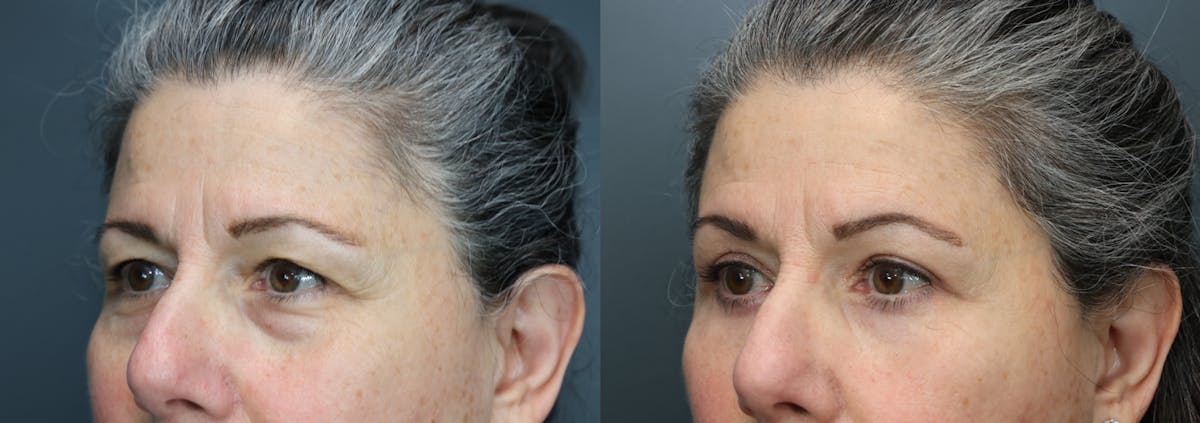 Blepharoplasty Before & After Gallery - Patient 119426 - Image 2