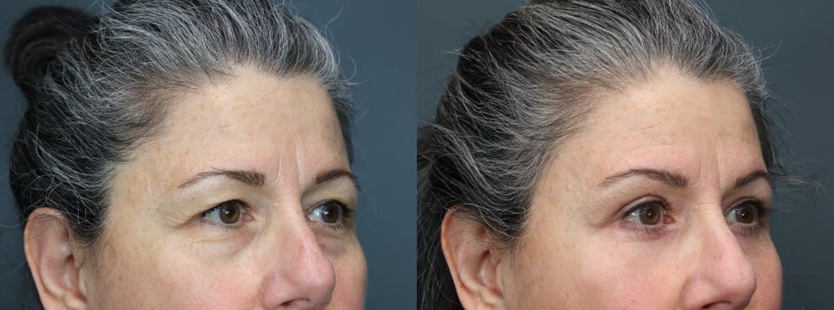 Blepharoplasty Before & After Gallery - Patient 119426 - Image 3