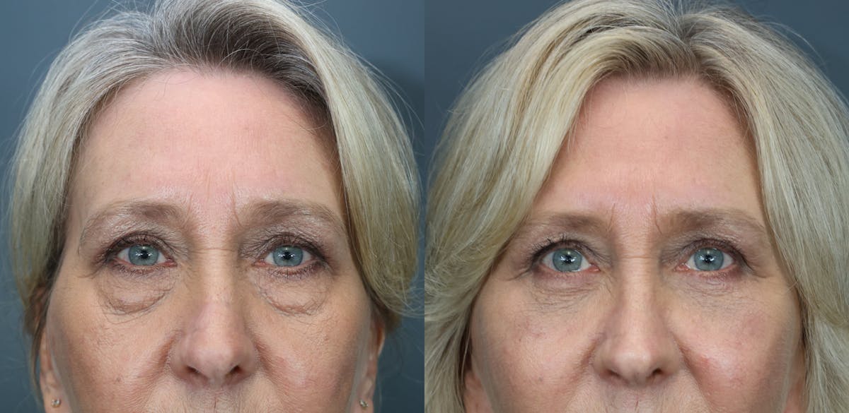 Blepharoplasty Before & After Gallery - Patient 346306 - Image 1