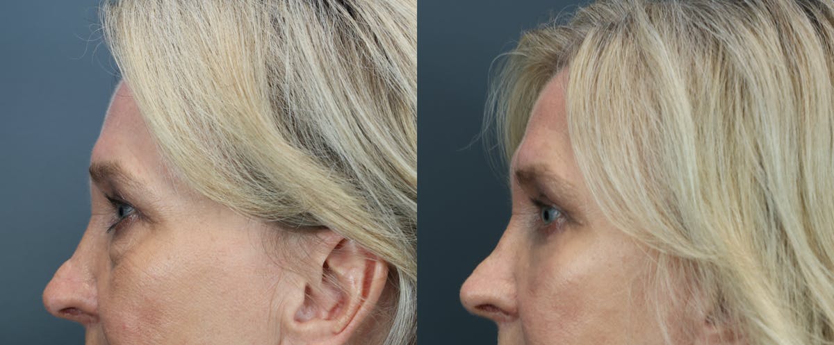 Blepharoplasty Before & After Gallery - Patient 346306 - Image 4