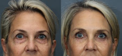Blepharoplasty Before & After Gallery - Patient 215691 - Image 1