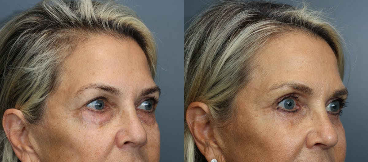 Eyelid Surgery Before & After Gallery - Patient 290864 - Image 2