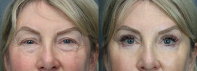 Blepharoplasty Before & After Gallery - Patient 200679 - Image 1